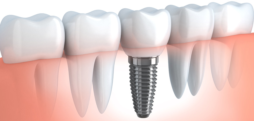 Dental implant