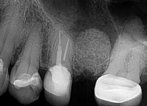 Patient Sinus Lift X-ray